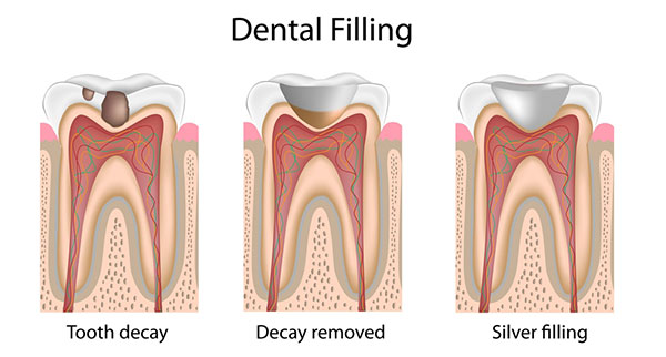 silver dental filling