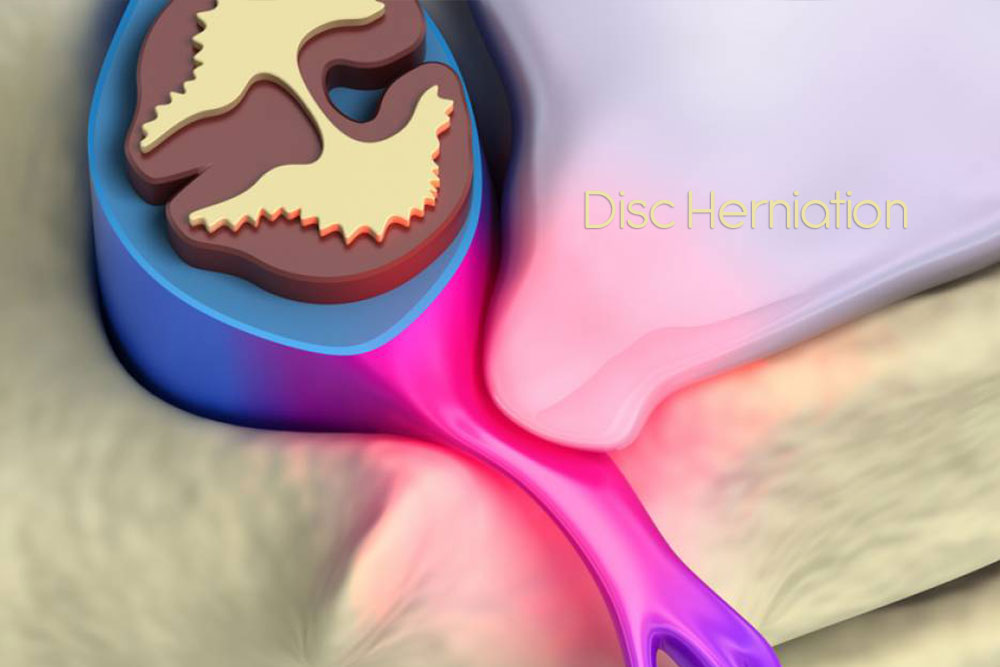 Suffering from Disc Herniation? Neuromuscular Therapy Can Save You from Surgery