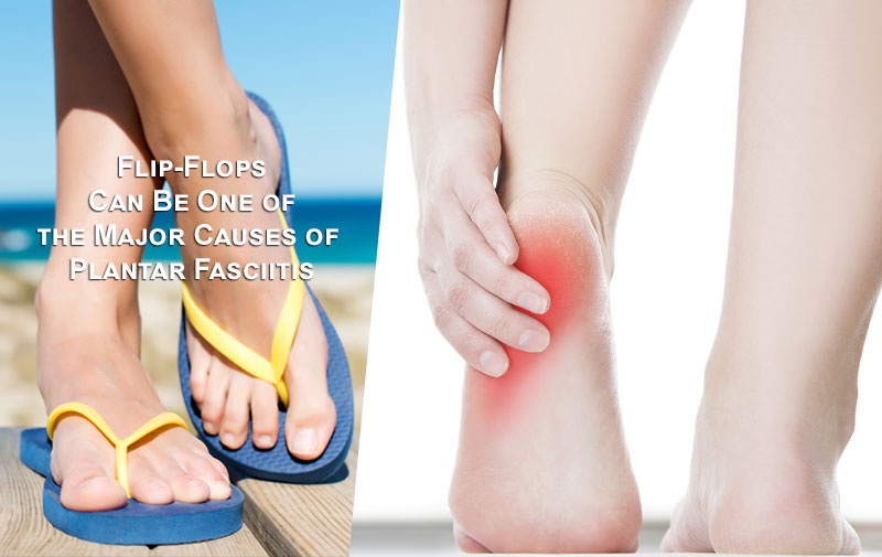 Learn How Flip Flops Can Be One of the Major Causes of Plantar Fasciitis