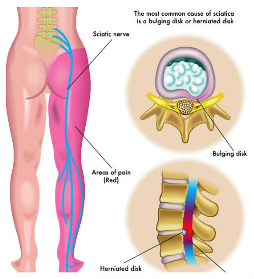 medical illustration of symptoms of the sciatica